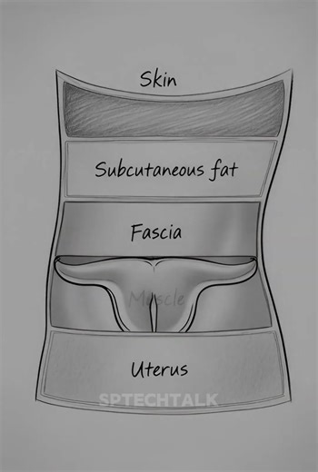 caesarean(C-section) Delivery lo nijanga em jarugutundi? 😳😥#sptechtalk