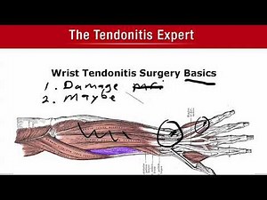 Wrist Tendonitis Surgery Basics - Better To Know Now Than Later