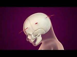 Scaphocéphalie - Craniectomie en H