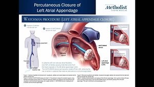 NOAC for Atrial Fibrillation Management