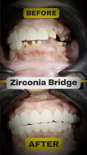 Fixing Zirconia Bridge - Step by Step || Best Dental Hospital || Happy Smiles