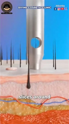 How Hair Transplant Works? FUE Procedure Explained | Natural Hair Regrowth