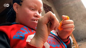 Albinos au Burundi, le défi de la normalité