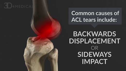 7.8K views · 88 reactions | Learn about the anterior cruciate ligament (ACL), an important stabilizing ligament of the knee that connects the femur to the tibia. Discover how it can tear in sports and physical activity, and the treatments that can assist in its healing! | Complete Anatomy | Facebook