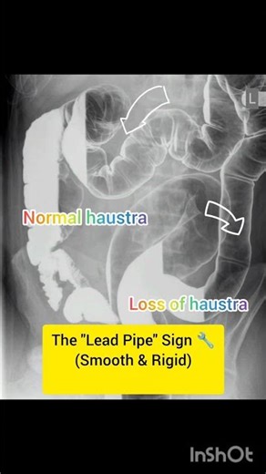 Why does his colon look like a METAL PIPE? 🪠🔧 (Lead Pipe Sign) #shorts #radiology #educational #neet