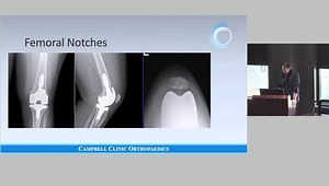 Adoption of Kinematic Alignment: My Learning Curve