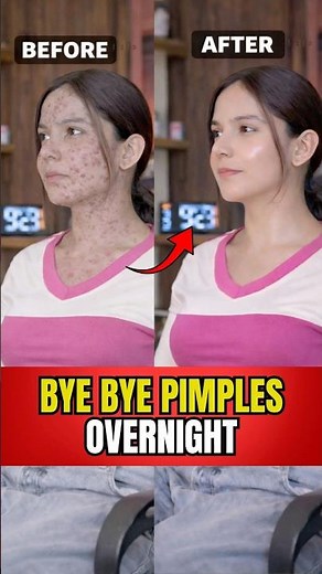 Top 1 Oil for Pimples