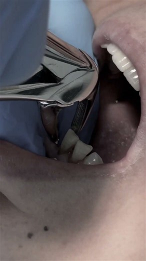 Extraction of lower anterior teeth with mobility #dentist