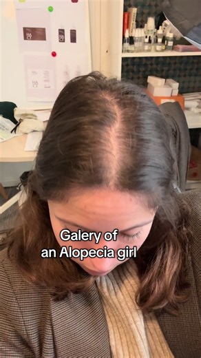 Galery of an Alopecia girl ❤️‍🩹 #alopecia #hairloss #chutedecheveux #alopecie #hairthinning