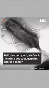A Helicobacter pylori é uma bactéria capaz de permanecer no estômago durante anos sem provocar sintomas evidentes. No entanto, em casos avançados, pode causar gastrite, úlceras e até câncer gástrico. 🔬 A descoberta desta bactéria mudou por completo a visão médica sobre as doenças gástricas. Barry Marshall, um dos pesquisadores chaves, demonstrou seu papel em ingerir bactérias e desenvolver gastrite. 💊 O tratamento consiste em uma combinação de antibióticos que erradica a infecção em 90% dos ca