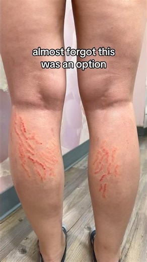 Inkless Stretch Mark Treatment | The Healing Process in Motion