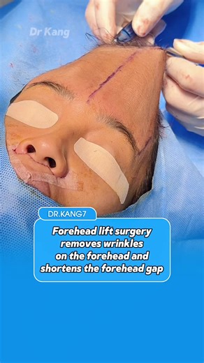 Forehead Lift: Enhance Your Facial Balance