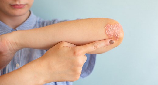 6 Psoriasis Treatment Options to Clear Your Symptoms Effectively