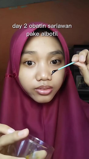 Obat Ampuh untuk Mengatasi Sariawan