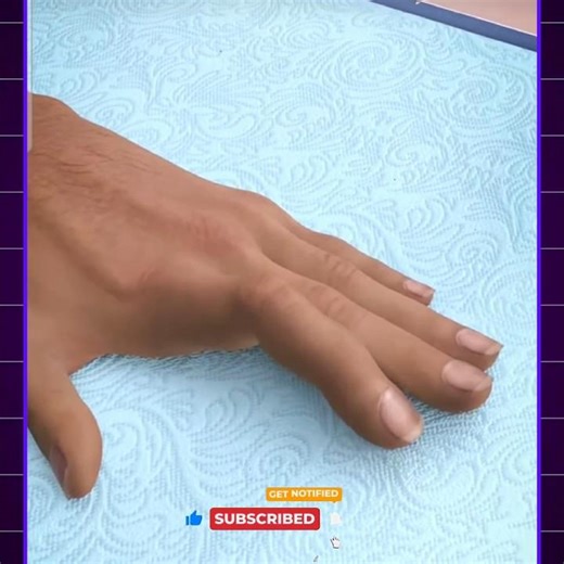 The Surgeon How Reattach Severed Finger #shorts