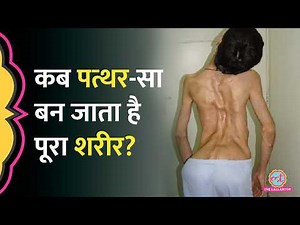 Rajasthan में 9 साल के बच्चे को रेयर बीमारी,पूरे शरीर में बनने लगती हैं हड्डियां! Stone Man Syndrome