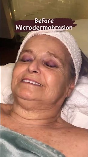 Esthetician Student Life: Before and After Microdermabrasion Results