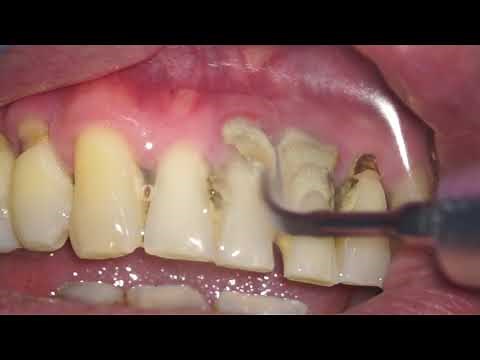 HEAVY CALCULUS TARTAR REMOVAL ULTRASONIC TIP DENTAL HYGIENE