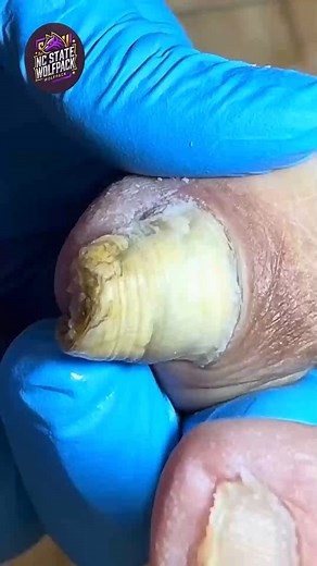 103K views · 472 reactions | Doctor-Approved Tips for Staying Active with Foot Pain #FootCareTips #EverydayCare #NailCareTips | NC State Wolfpack on TheWolfpacker.com | Facebook