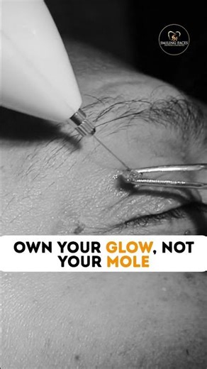 Best Mole Removal Treatment | Laser Mole Removal #moleremoval #shorts #viral