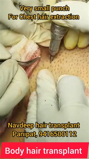Chest hair extraction with micro punch FUE hair transplant technique.