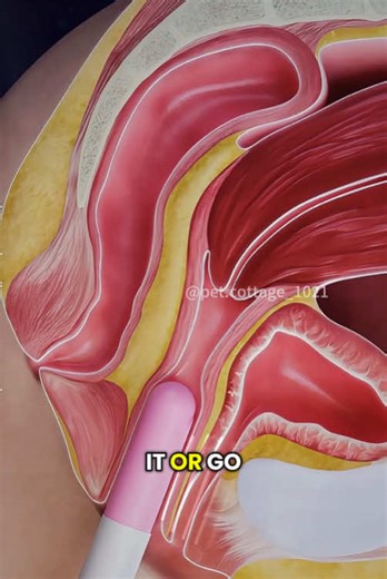 What is V-Tone Procedure and How It Works? (3D Animation) #vtonetreatment #vtonesurgery #rejuvination #tightening #musclestightening #pelvicfloor #vtoneinsertion #medical3danimation #3dmedicalanimation