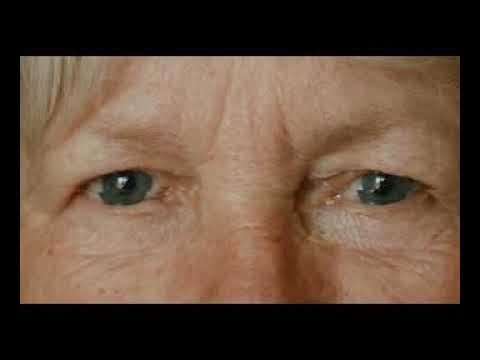 Medicare Advantage Vision Benefit