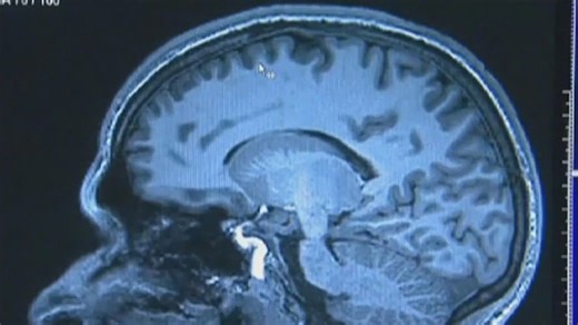 Cause of long COVID 'brain fog'