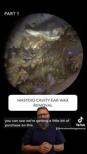 MASTOID CAVITY EAR WAX REMOVAL - PART 1 #audiologyassociates #ear #earwax #earwaxremoval #earwaxcleaning