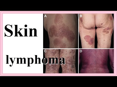 skin lymphoma