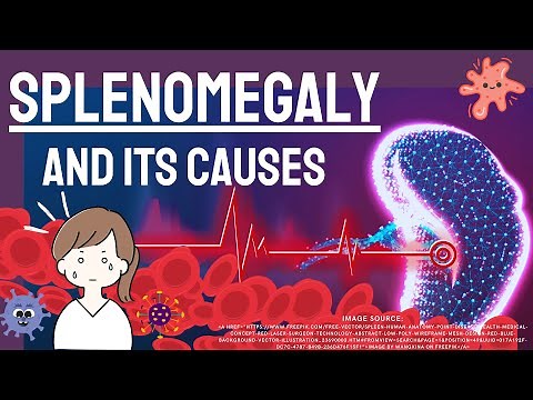 what is Splenomegaly? What Causes a spleen to enlarge?