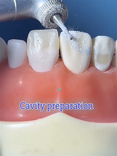 Class 4 cavity preparation and composite restoration 🦷 #dentistry #dentaleducation #dentist #foryou #viral
