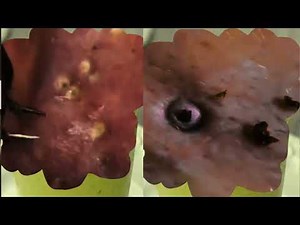 Severe Jigger Removal and Treatment