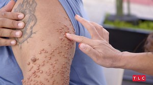 1.4M views · 11K reactions | This patient has had a bumpy ride since he was a teenager… Can Dr. Lee finally fix this extreme case? #DrPimplePopper | Dr. Pimple Popper | Facebook