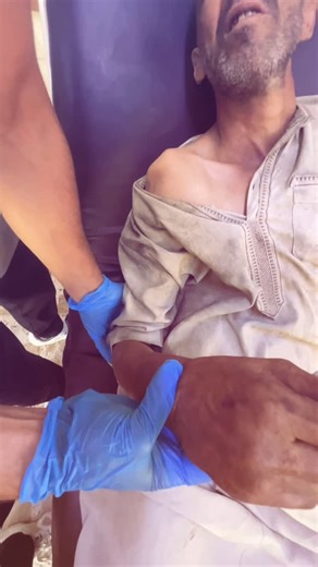 Hassan on Instagram‎: "External rotation method This simple technique has a good rate of success. With the patient reclining at 45°, slowly and gently (without force) externally rotate the shoulder to 90°. If the dislocation has not yet reduced, forward flex (elevate) the shoulder slowly شلون نرجع ( خلع الكتف ) طريقة سهلة وبسيطة . اول خطوة : يستلقي المريض بوضعية ( Fowler’s position ) يعني شبه جالس . ثاني خطوة : نثني الساعد والعضد خاطر يشكلون زاوية ٩٠ درجة . ثالث خطوة : نبدي ندور الساعد للخارج بش