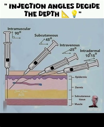 “Injection Angles decide the depth 📐💡”