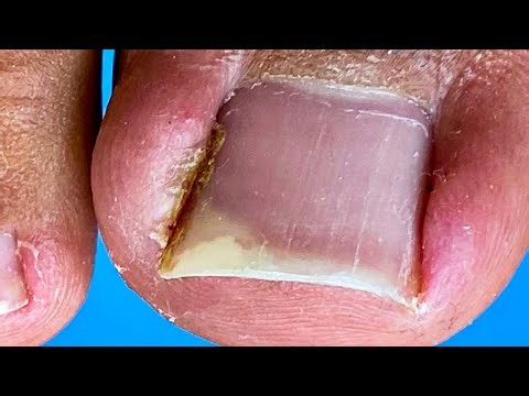 Swollen Toes With Ingrown Toenails, Professional Pedicure【Crazy pedicure room】