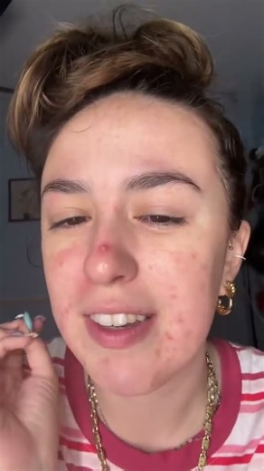 omg this is the biggest pimple i’ve ever had in my life!!!!!