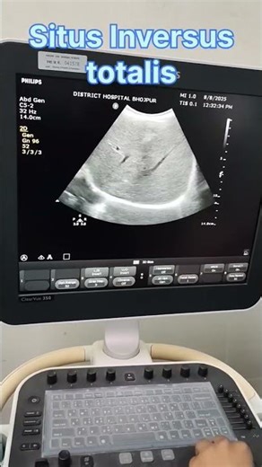 Situs Inversus Totalis: Everything is mirrored ! #Radiology #MedicalMystery #Dextrocardia #Anatomy