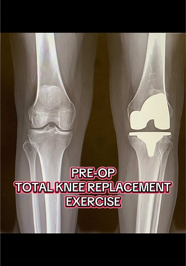 Pre-Op Exercises for Total Knee Replacement Patients
