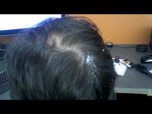 Staplectomy - Surgical Removal of Staples from Head