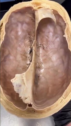 The Falx Cerebri separates the two cerebral hemispheres. #brain #science #anatomy #anatomy101