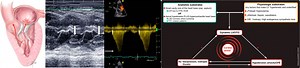 Dynamic Left Ventricular Outflow Tract Obstruction: Underestimated Cause of Hemodynamic Instability | RECAPEM