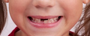 Children's Oral Health: Tooth Decay and Prevention - Dentaly.org