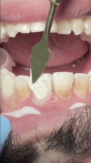 Deep anterior tooth cavity composite restoration #dentist