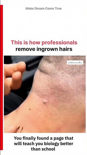 💇This is how professional remove ingrown hairs✂️ | MDCT