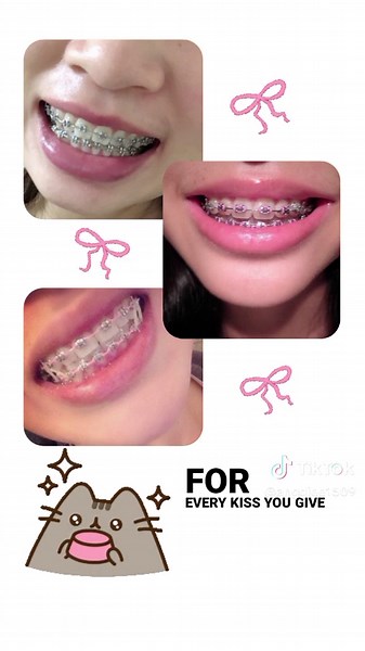 how braces talk to me🥺🤞🏻#fyppppppppppppppppppppppp #fyp #fypシ #content #braces #healthyteeth