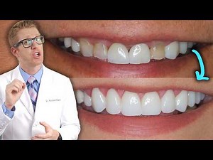 Smile MAKEOVER With Dental Crowns & Gum Lift: Complete Procedure by a Cosmetic Dentist. 😁