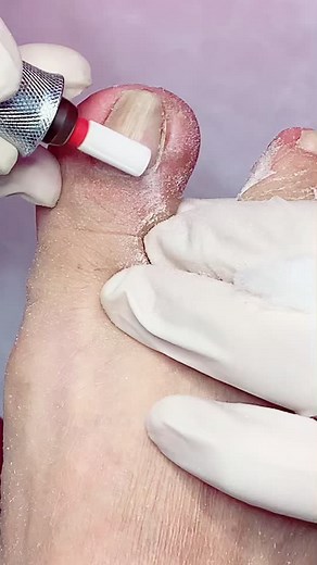 Extracción de uña encarnada 💪🏼 #podologos88 #podologia #uñaencarnada