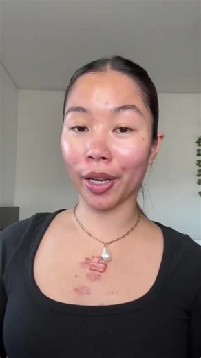 That One Pimple Full of Blood: A Pimple Patch Story 🥴